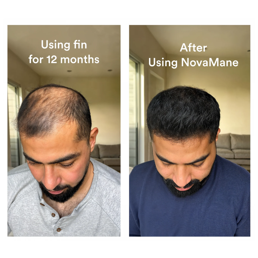HairRegrow Kit