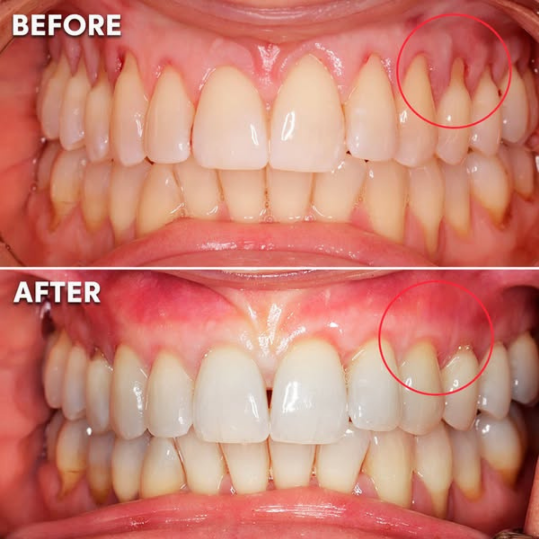 Gum Rejuvenation Device