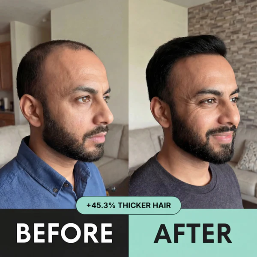 HairRegrow Kit