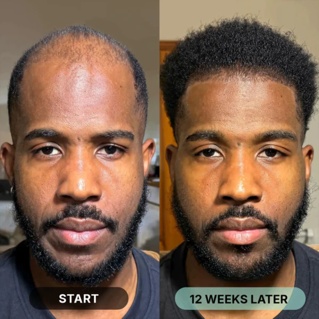 HairRegrow Kit