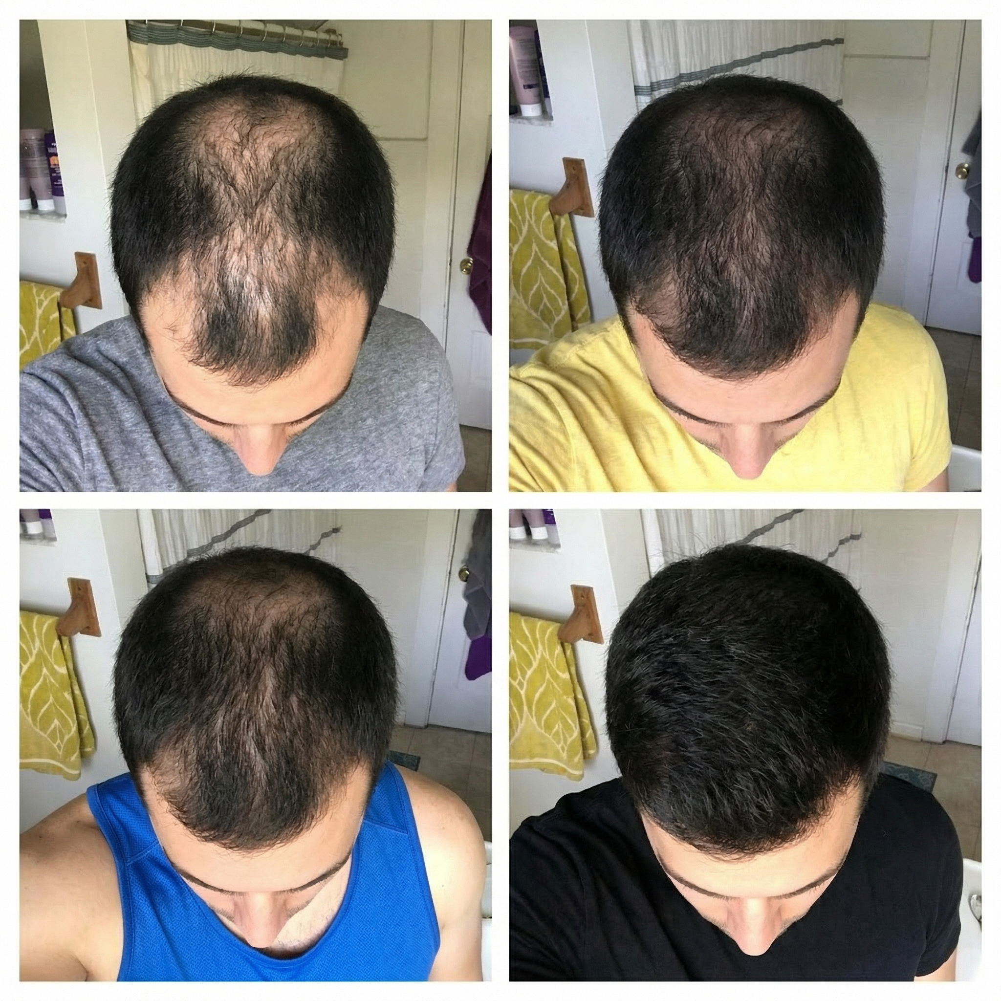 HairRegrow Kit